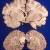 2A4 Microencephaly vera, microcephaly vera, 770 gm (Case 2) 1