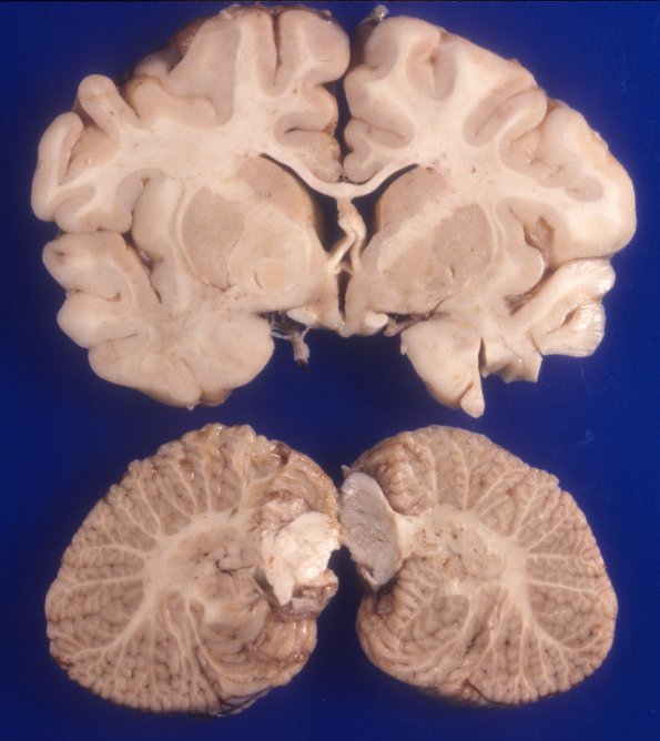 2A4 Microencephaly vera, microcephaly vera, 770 gm (Case 2) 1