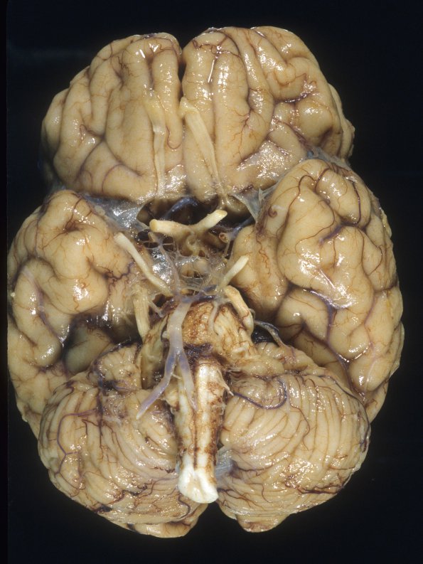 3A1 Micrencephaly vera, microcephaly vera, 700 gm, adult (Case 3) 1