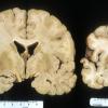 Microcephaly-Micrencephaly