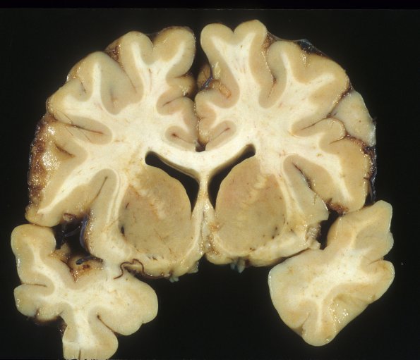 3A5 Micrencephaly vera, microcephaly vera, 700 gm, adult (Case 3) 5