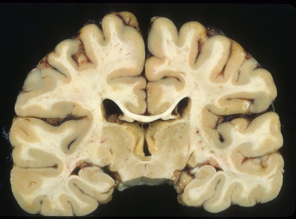 3A6 Micrencephaly vera, microcephaly vera, 700 gm, adult (Case 3) 4