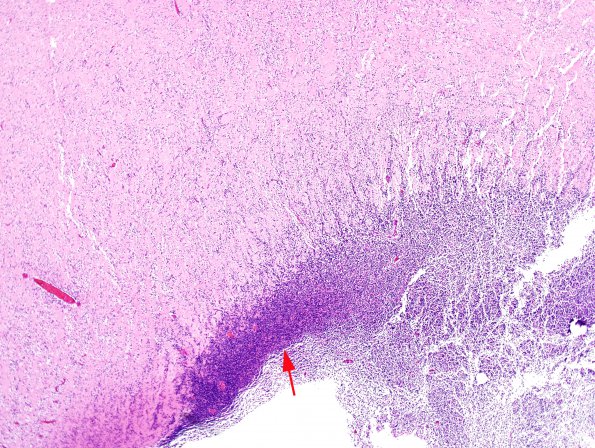 1A1 Migration, neuroblasts & glioblasts, 27 wks (Case 1) H&E 4