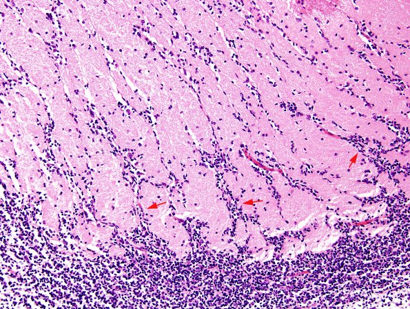 1A2 Migration, neuroblasts & glioblasts, 27 wks (Case 1) H&E 1