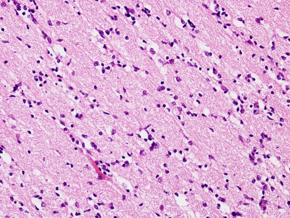 1A3 Migration, neuroblasts & glioblasts, 27 wks (Case 1) H&E 2