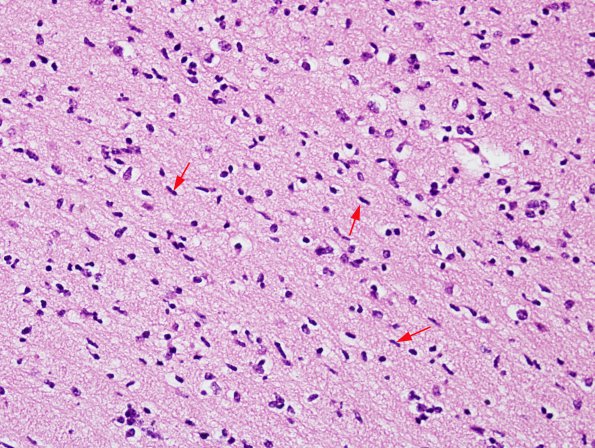 1A4 Migration, neuroblasts & glioblasts, 27 wks (Case 1) H&E 3