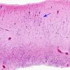 2A1 Migration Germinal Matrix (Case 2) H&E 3