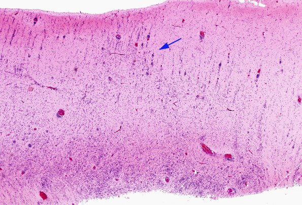 2A1 Migration Germinal Matrix (Case 2) H&E 3