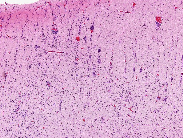 2A2 Migration Germinal Matrix (Case 2) H&E 2