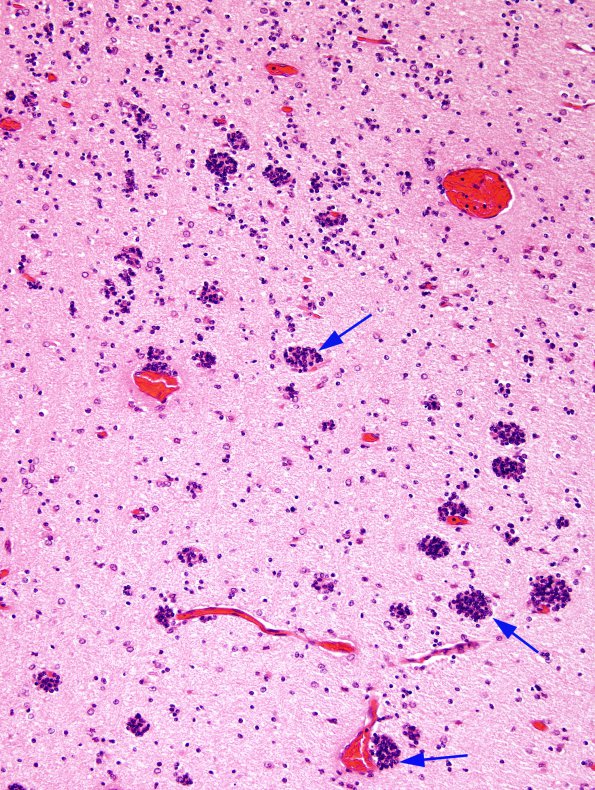 2A3 MigrationGerminal Matrix (Case 2) H&E 1