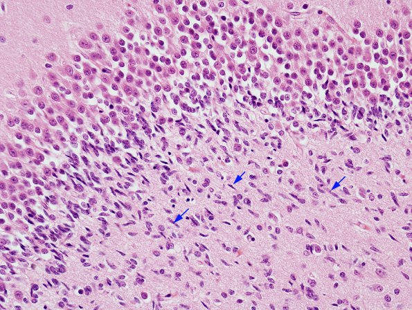 3A3 Dentate Immature Cells (Case 3) H&E 3