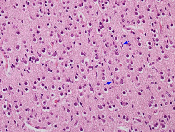 4A2 Neurons vs Glia, immature, migrating (DDx microglia, Case 4), 32 week cortex H&E 1