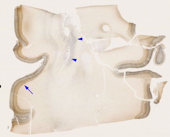 5B1 Maturation Cortex, 26 wks (Case 5) NeuN whole mount