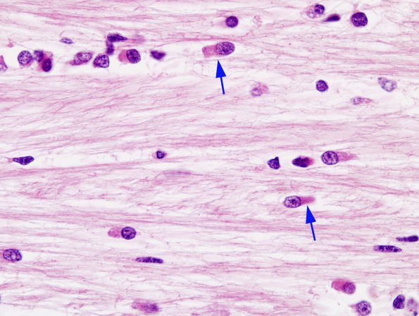 6 Myelination glia (Control term infant, ts) 100x  1