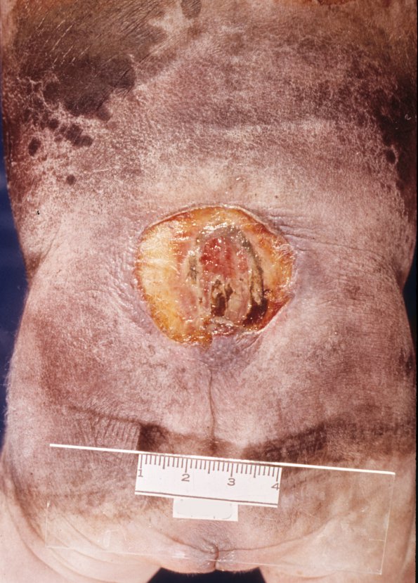 1 Myelomeningocoele (Case 1) 1