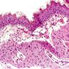 10A1 Myelomeningocele (Case 10) 1