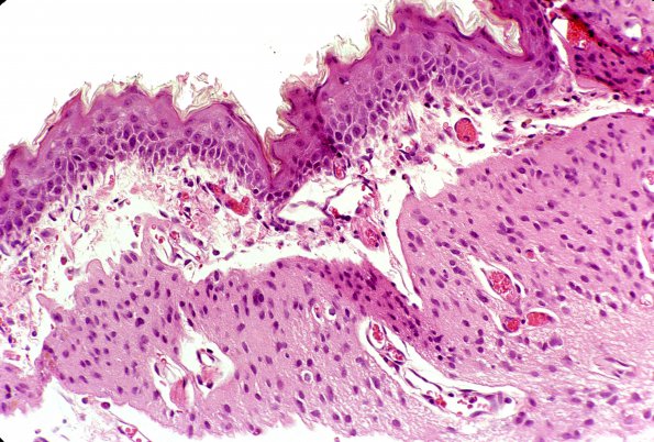 10A1 Myelomeningocele (Case 10) 1