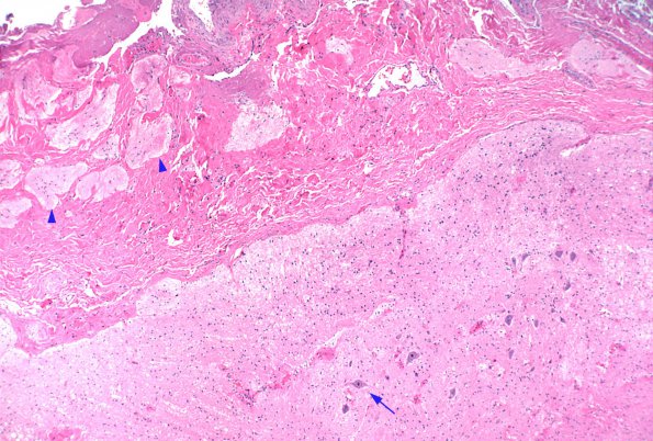 10A2 Myelomeningocele (Case 10) 1