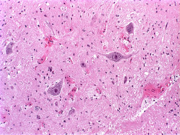 10A3 Myelomeningocele (Case 10) 2