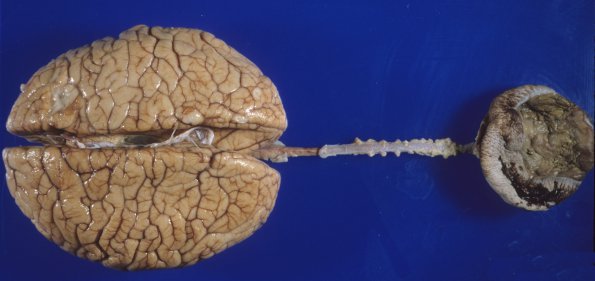 3A1 Myelomeningocoele  (Case 3) 1