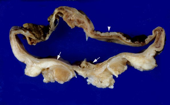 3A2 Myelomeningocoele  (Case 3) 1