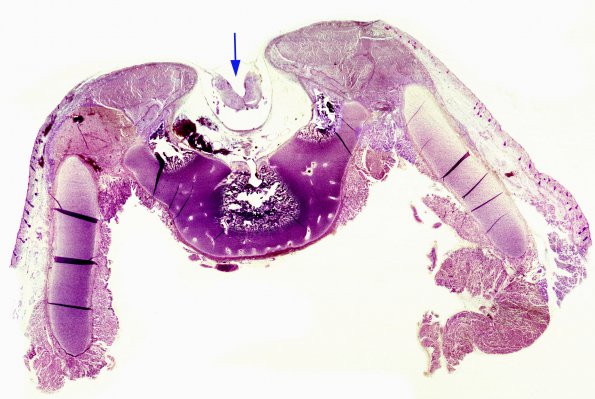 4 Myelomeningocoele (Case 4) 2