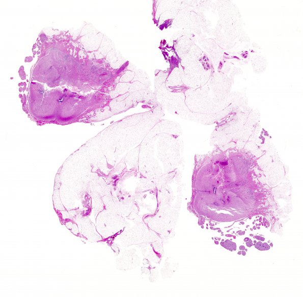 5A1 Myelomeningocele, dysplastic spinal cord (Case 5) H&E whole mount 2