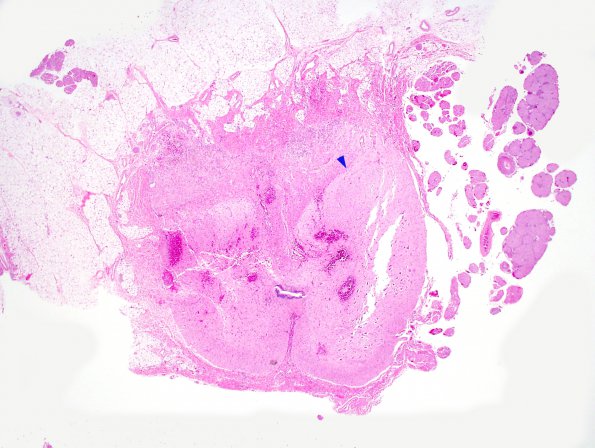 5A2 Myelomeningocele, dysplastic spinal cord H&E 1