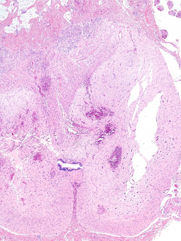 5A3 Myelomeningocele, dysplastic spinal cord (Case 5) H&E 9