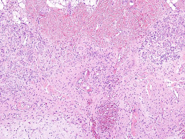 5A4 Myelomeningocele, dysplastic spinal cord (Case 5) H&E 