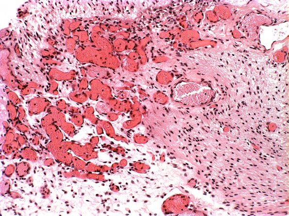 6A1 Myelomeningocele (Case 6) 2A