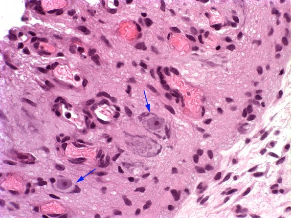 6A2 Myelomeningocele (Case 6) 3