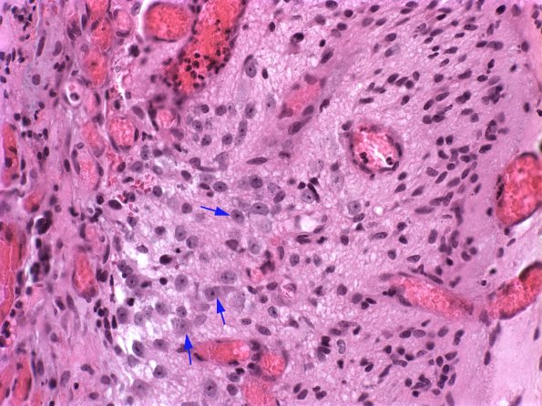 6A3 Myelomeningocele (Case 6) 5