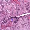 6A5 Myelomeningocele (Case 6) 4