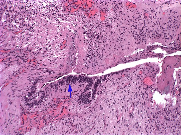 6A5 Myelomeningocele (Case 6) 4