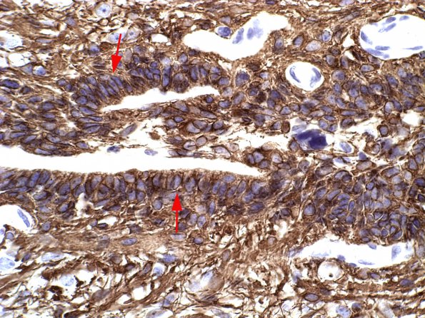 6A6 Myelomeningocele (Case 6) GFAP1