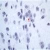 6B1 Myelomeningocele (Case 6) NEG