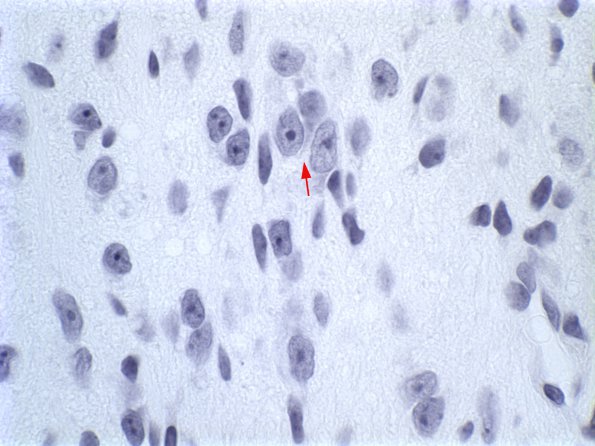 6B1 Myelomeningocele (Case 6) NEG