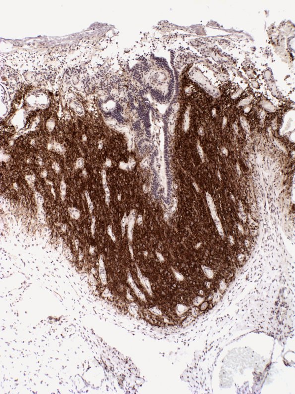 6B2 Myelomeningocele (Case 6) SYN