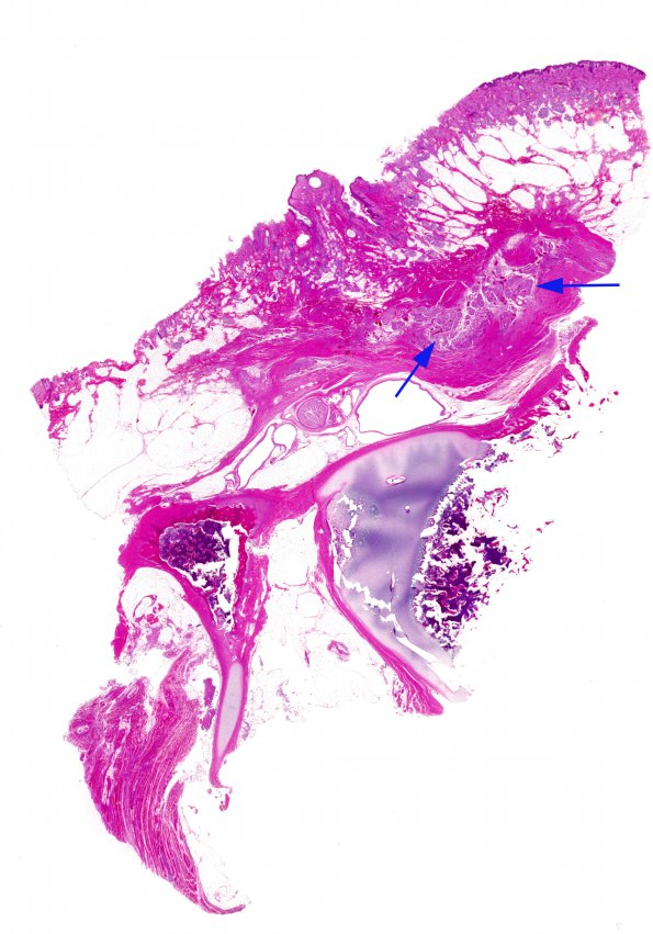 7A1 Myelomeningocele, SP Surgery, (Case 7, N20) H&E whole mount