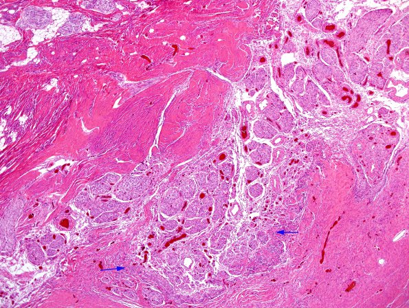 7A2 Myelomeningocele, SP Surgery, Arnold Chiari (Case 7, N20) H&E 3