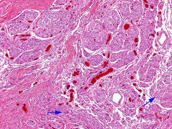 7A3 Myelomeningocele, SP Surgery, Arnold Chiari (Case 4, N20) H&E 5