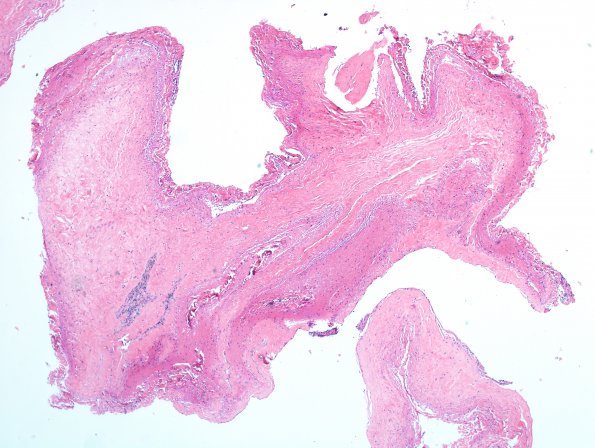 8A1 Myelomeningocele (Case 8) H&E whole mount