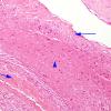 8A2 Myelomeningocele (Case 8) H&E 1