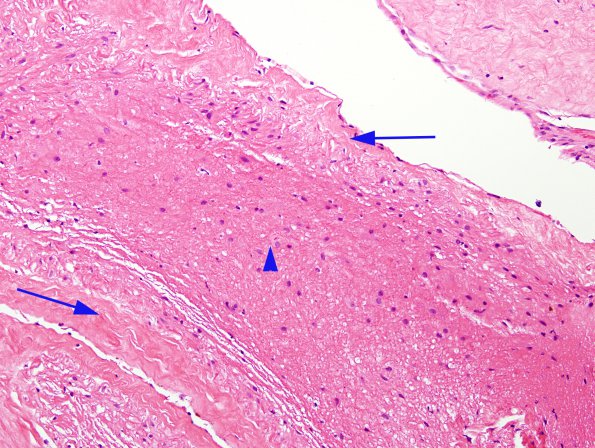 8A2 Myelomeningocele (Case 8) H&E 1