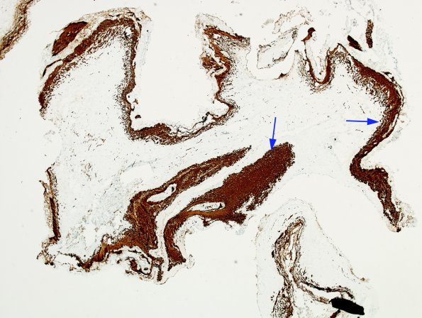 8B1 Myelomeningocele (Case 8) GFAP whole mountA