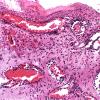 9A1 Myelomeningocele (Case 9) 2