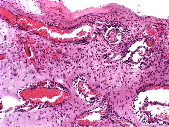 9A1 Myelomeningocele (Case 9) 2