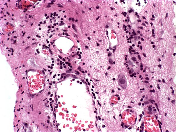 9A2 Myelomeningocele (Case 9) 3