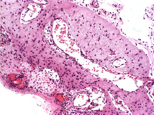 9A3 Myelomeningocele (Case 9) C